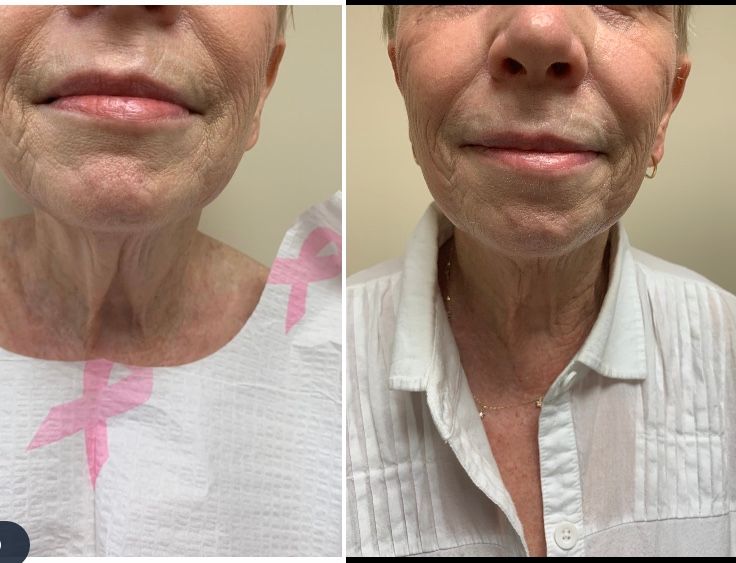 Renuvion/J Plasma neck at 6 weeks Dr Varano Renuvion/J Plasma neck at 6 weeks Dr Varano